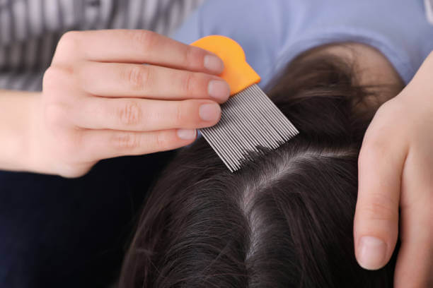 How To Remove Lice From Hair Permanently