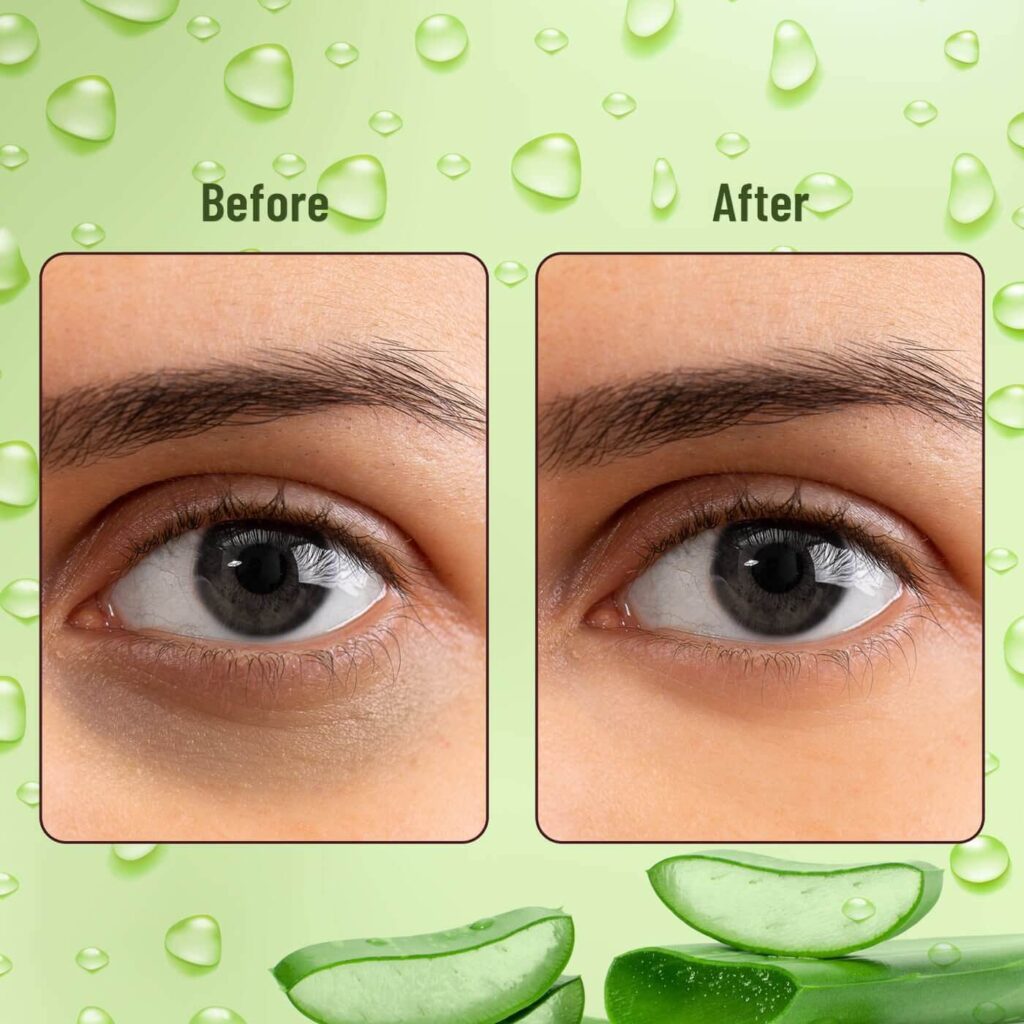 How to Remove Dark Circles With Aloe Vera before and after image